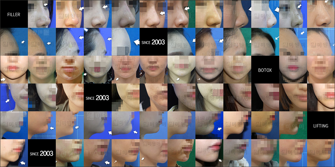 SINCE 2003 MI&MI, 시술후사진모음 대전모공, 둔산동모공, 대전여드름, 둔산동여드름, 대전여드름흉터, 둔산동여드름흉터, 대전MTS, 둔산동MTS, 대전PDT, 둔산동PDT, 대전알라딘필, 둔산동알라딘필