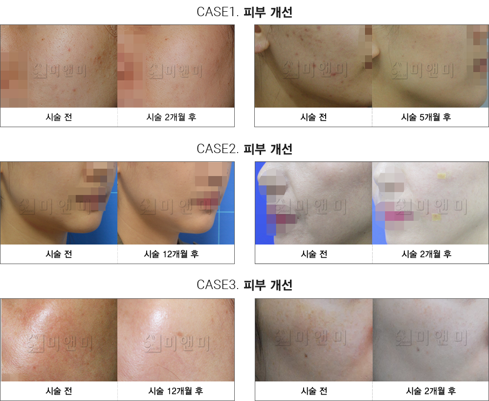 시술전후사진 : 대전피부과-둔산동피부과 아름다움을 찾은 자신감 대전피부과 미앤미