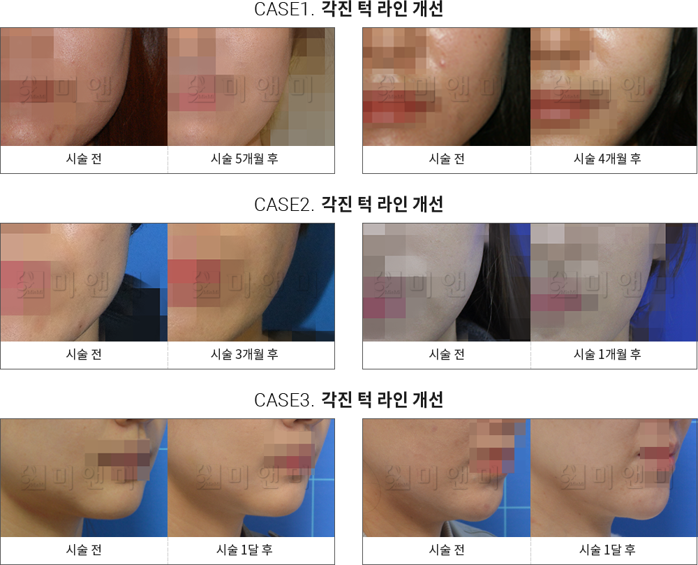 시술전후사진 사각턱 보톡스 : 각진 턱 라인 개선 대전사각턱보톡스, 둔산동사각턱보톡스
