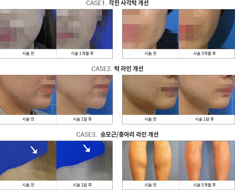 시술전후사진 승모근 보톡스 : 각진 사각턱 개선,턱 라인 개선,승모근/종아리 라인 개선 대전승모근보톡스, 둔산동승모근보톡스, 대전보톡스, 둔산동보톡스, 대전종아리보톡스, 둔산동종아리보톡스, 대전쫑알주사, 둔산동쫑알주사