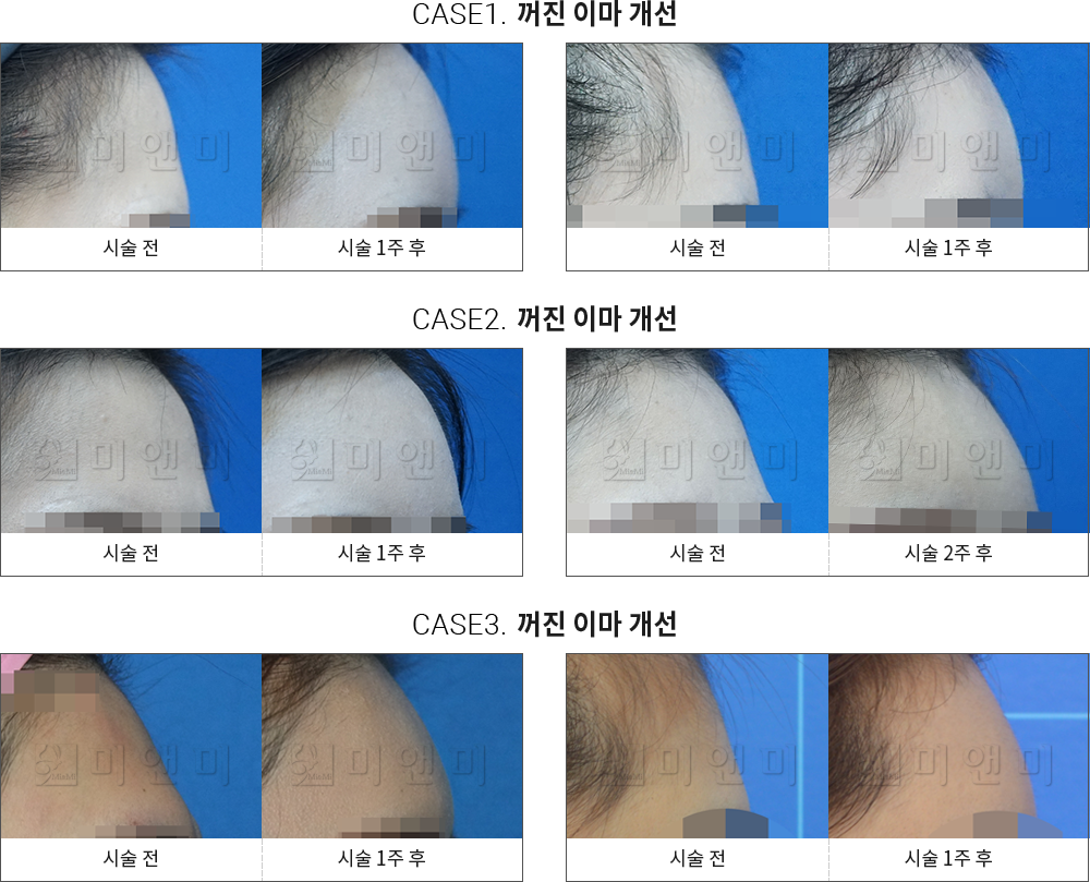 시술전후사진 이마필러 : 무턱개선 대전이마필러, 둔산동이마필러, 대전필러, 둔산동필러, 대전코필러, 둔산동코필러, 대전무턱필러, 둔산동무턱필러, 대전볼필러, 둔산동볼필러, 대전애교필러, 둔산동애교필러, 대전팔자필러, 둔산동팔자필러, 대전입술필러, 둔산동입술필러