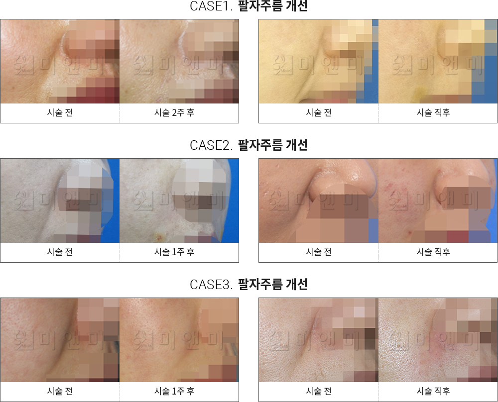 시술전후사진 팔자필러 : 팔자주름 개선 대전팔자필러, 둔산동팔자필러